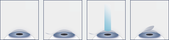 LASIK Diagram