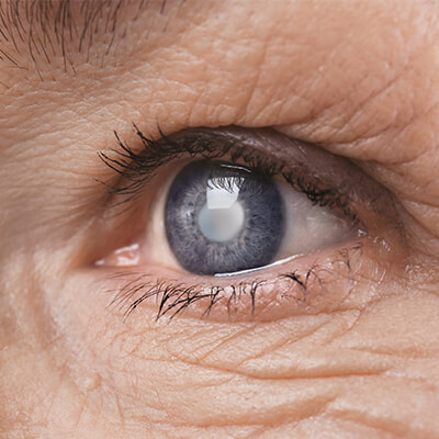 Closeup of an eye with a cataract