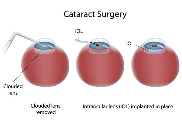 IN illustration of the stages of cataract surgery