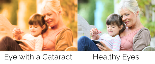 Vision With and Without Cataracts