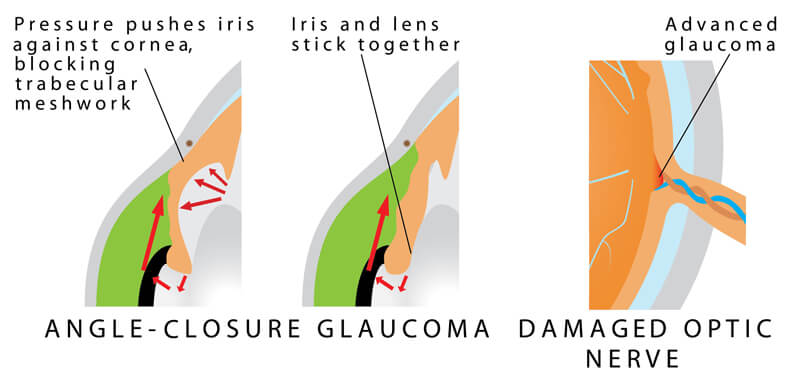 Closed Angle Glaucoma