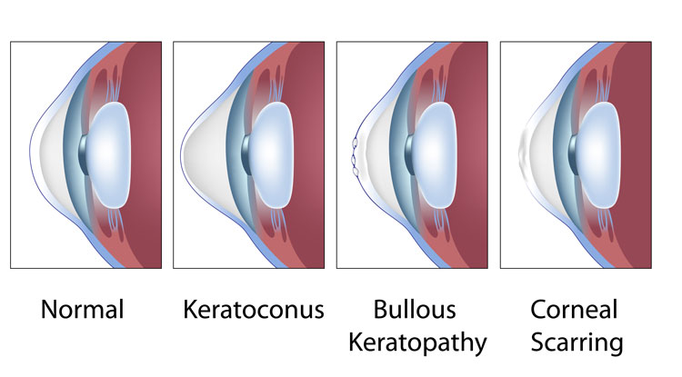 Cornea Conditions