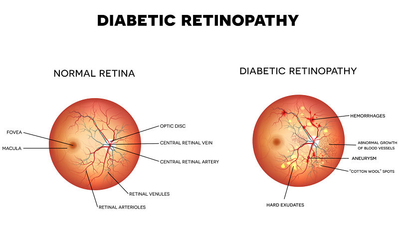 Diabetic Retinopathy 