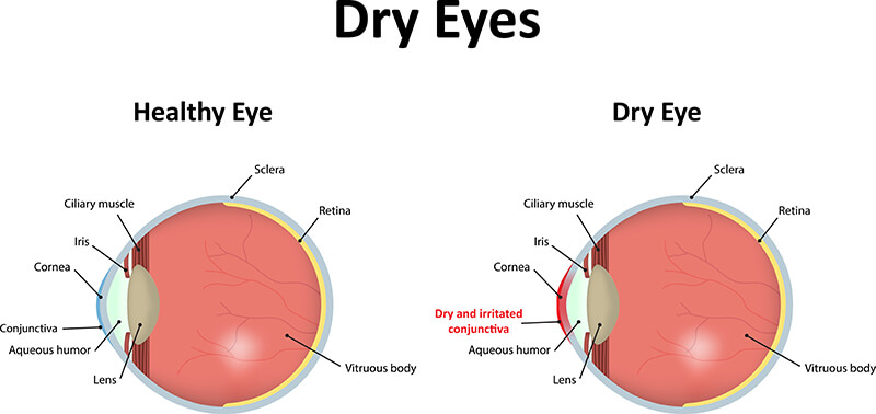 Dry Eye Chart