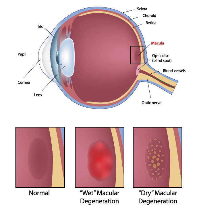 Diagram of Macular Degeneration