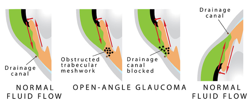 Open Angle Glaucoma