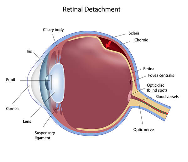 Retinal Detachment Diagram